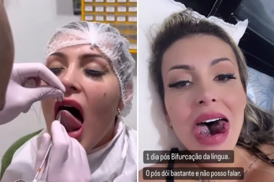 Urach realiza procedimento de 'língua de cobra' para aumento de prazer