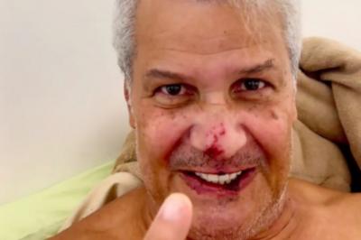 Sikêra Jr. aparece com rosto machucado após alta hospitalar